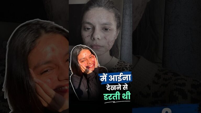 Acne ने मेरा Confidence तोड़ा, तो मैंने खूबसूरती के मायने ही बदल दिए।